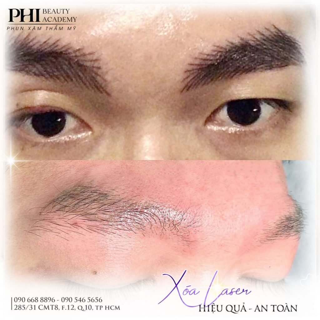 Xóa xăm chân mày bằng công nghệ laser