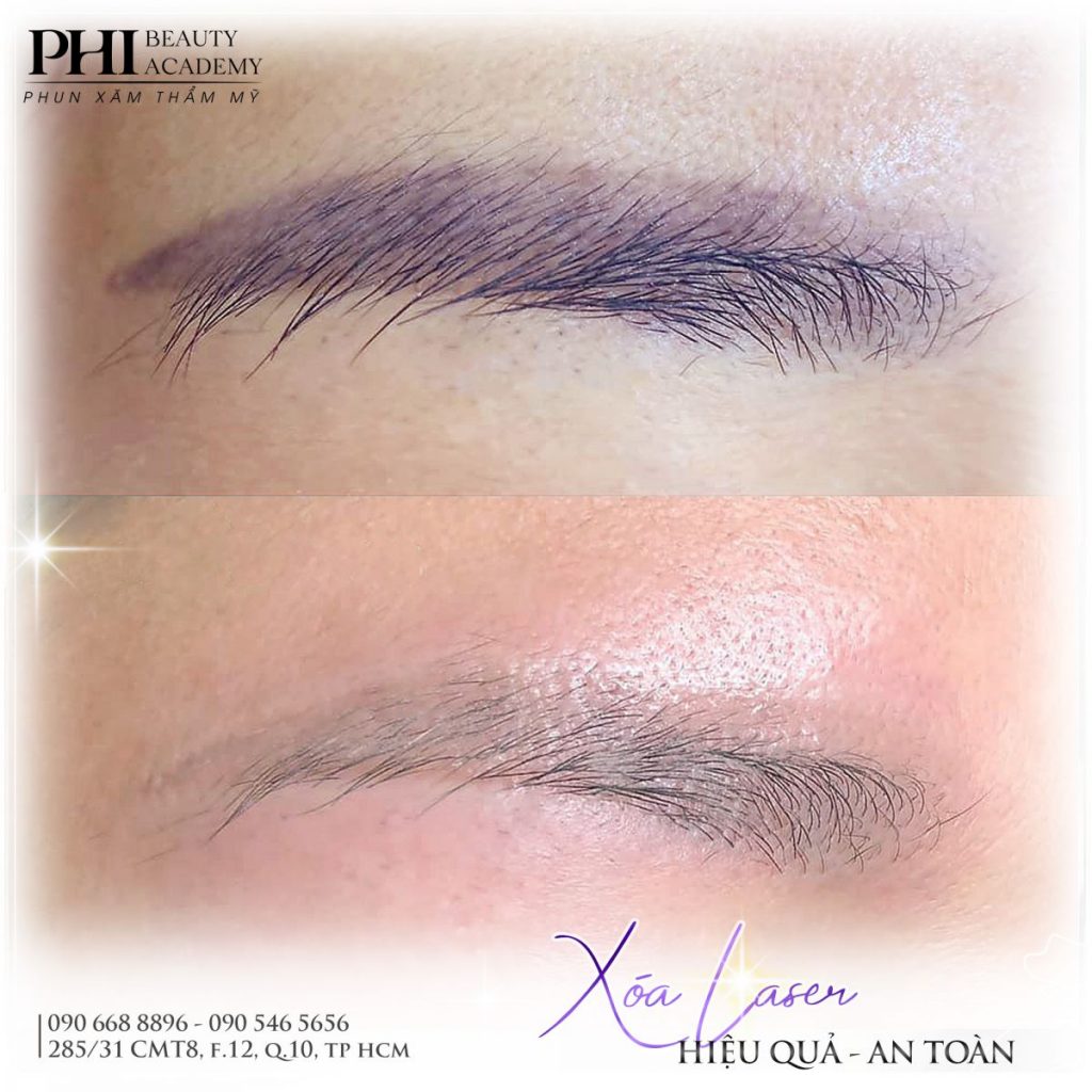 Xóa xăm chân mày bằng công nghệ laser