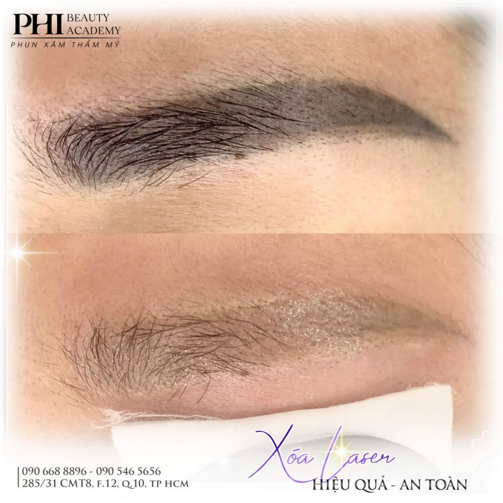 Xóa xăm chân mày bằng công nghệ laser