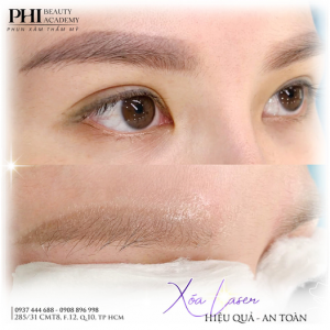 xoa may laser lam lai chan may co bam mau khong