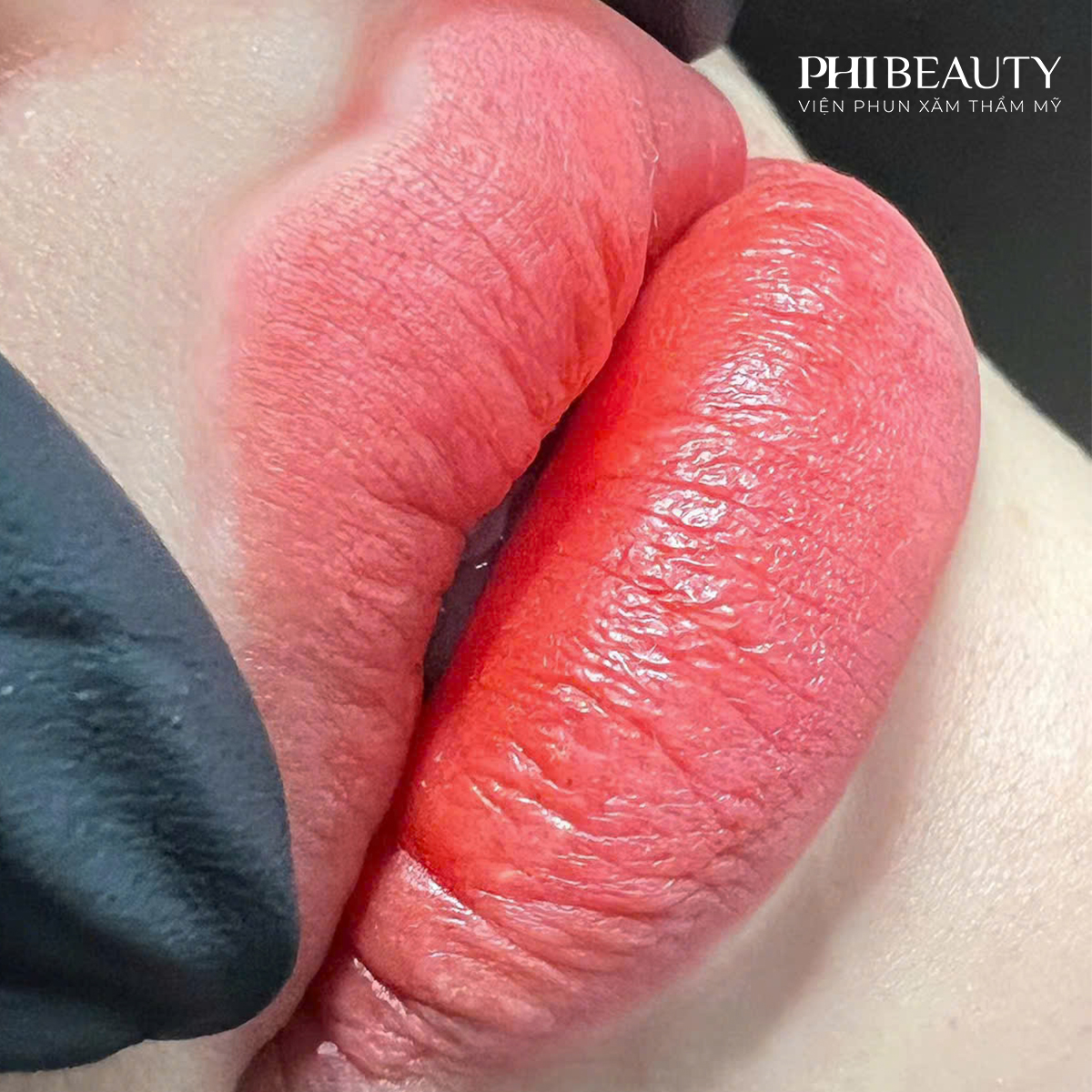 Kết quả phun môi cho người đang niềng răng tại Phi Beauty, môi hồng tự nhiên và căng mọng