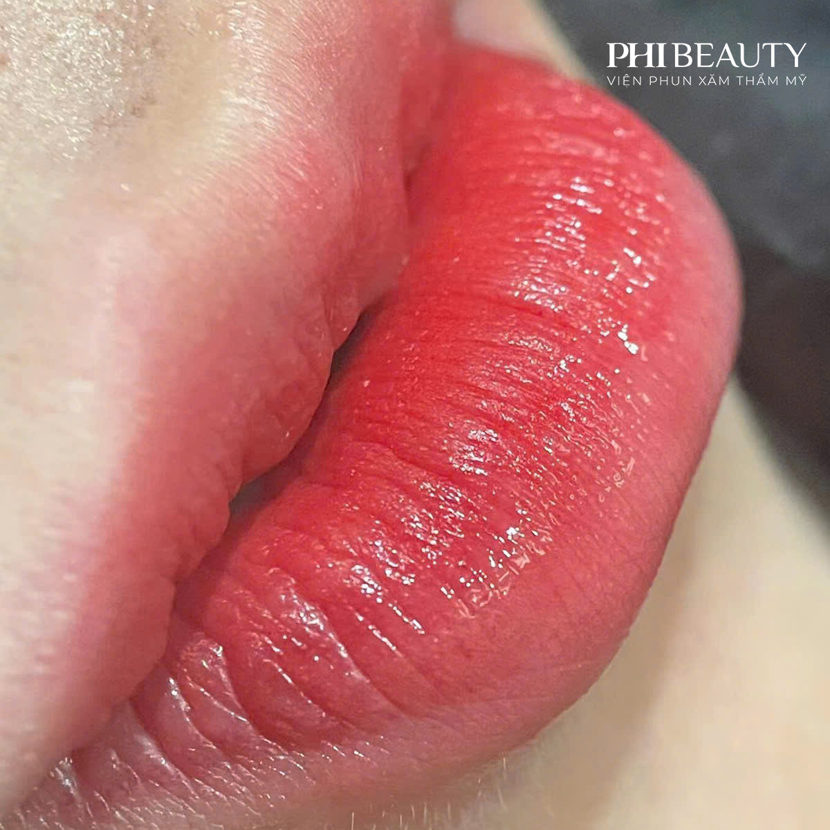 Quy trình phun môi an toàn cho khách hàng đang niềng răng tại Phi Beauty